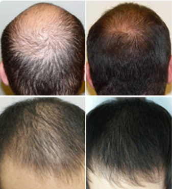 Contraindicazioni - fa male - effetti collaterali - Grow Hair Active